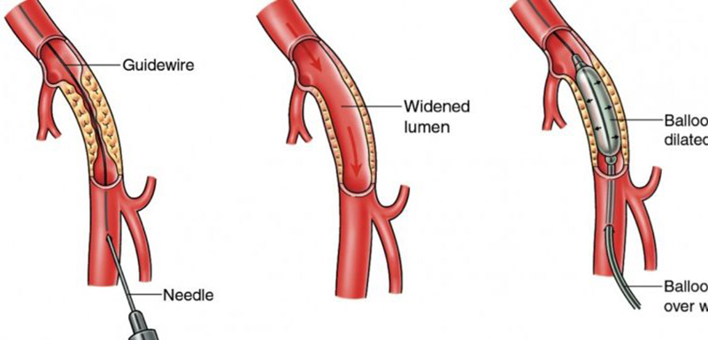 Peripheral Angiography And Angioplasty