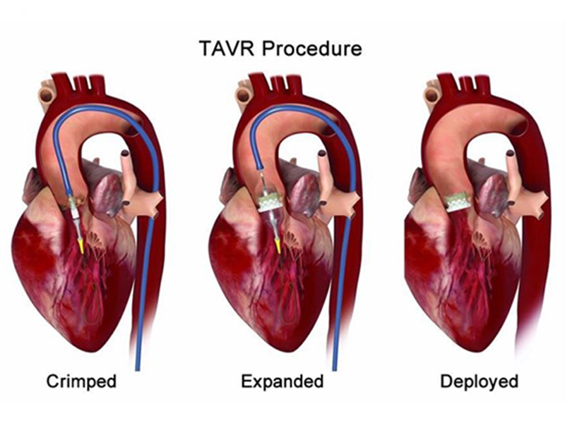 Transcatheter Aortic Valve Replacement