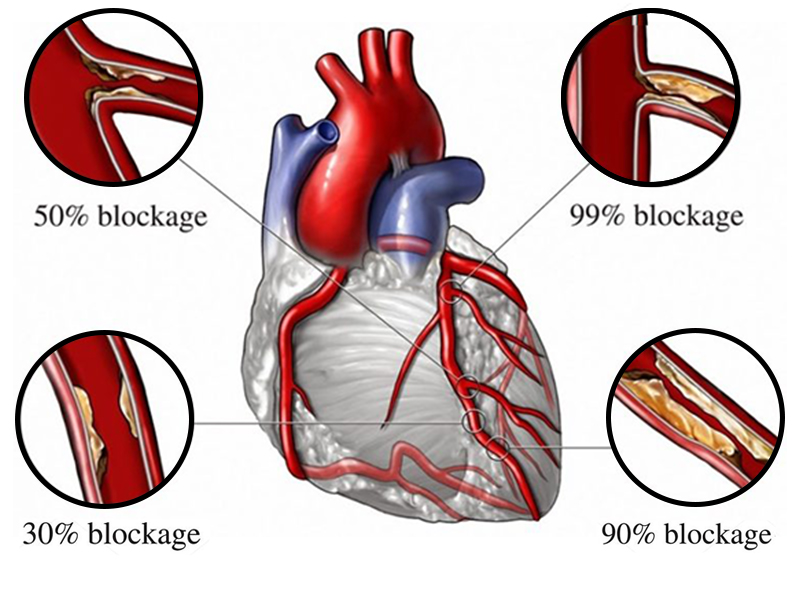 Angiography