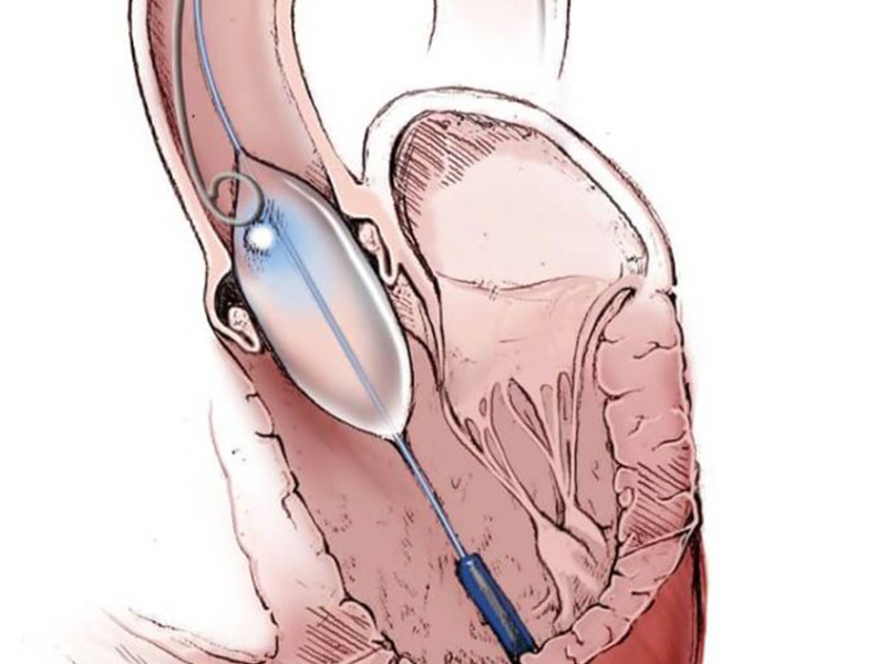 Balloon Valvuloplasty