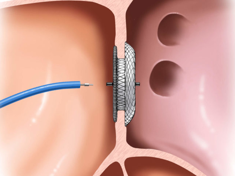 Device Closure Of ASD/VSD/PDA