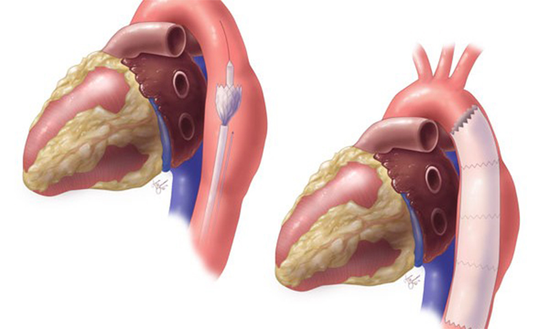 Evar & Tevar For Aortic Dissection & Aneurysm