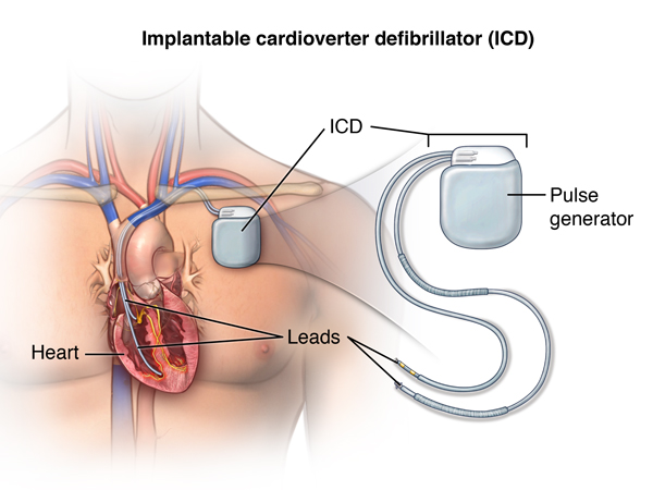 ICD & CRT IMPLANTATION
