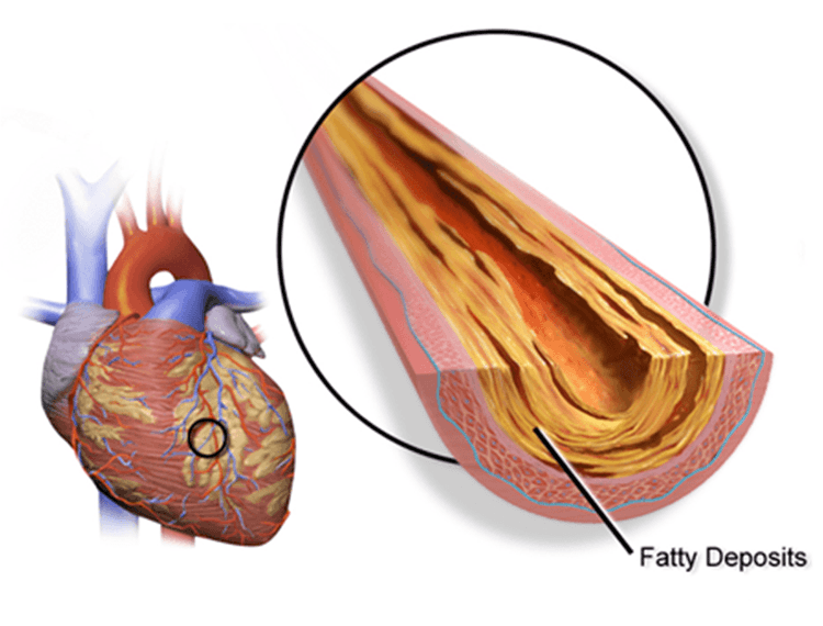 Primary Angioplasty For Acute MI
